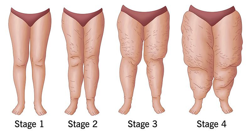 Lipedema